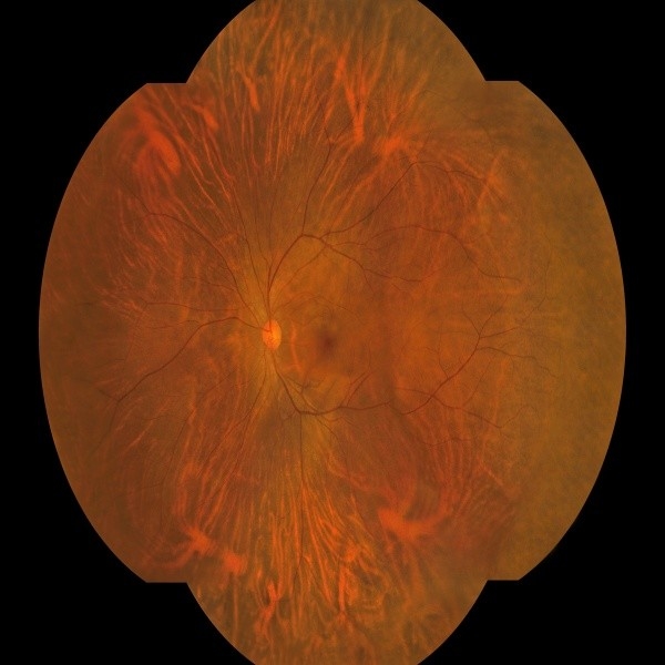Câmera de fundo de grande ângulo de 176 graus com uma chave e captura binocular para dispositivos médicos oftalmológicos